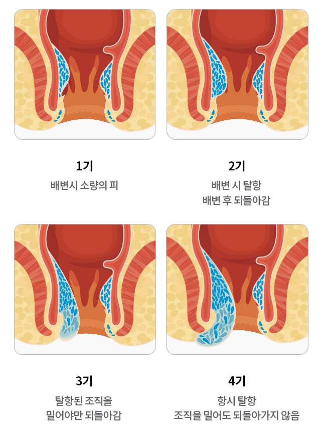 도플러 초음파 검사