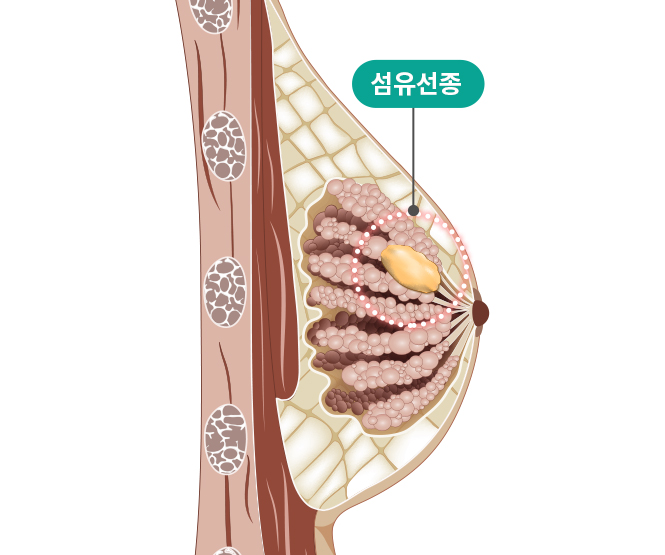 유방양성질환